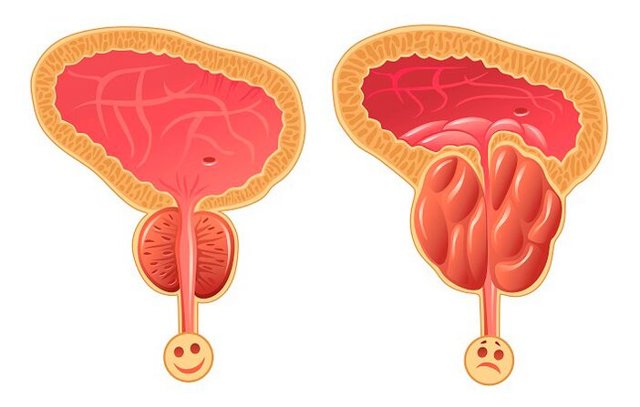 Prostata normala eta hanturatua