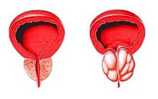 Prostata egoera normalean (ezkerrean) eta prostatitisarekin hanturatuta (eskuinean)