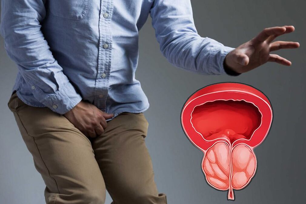 Prostatitisa berehalako tratamendua behar duen gizon batean