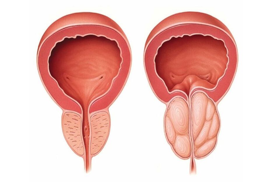 prostata normala eta hanturatua